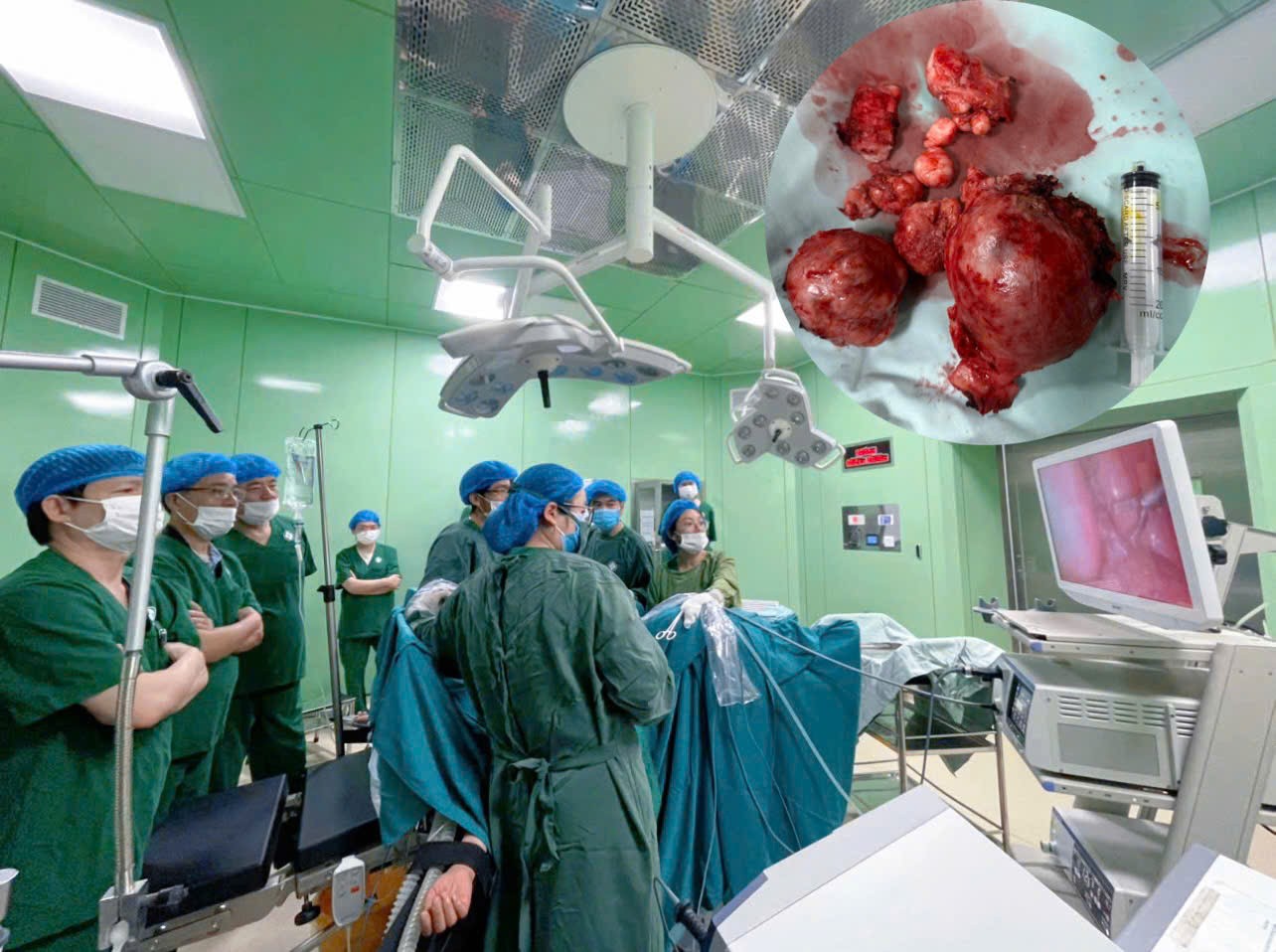 PHẪU THUẬT NỘI SOI U CƠ TRƠN TỬ CUNG- GIẢI PHÁP ÍT XÂM LẤN CHO BỆNH NHÂN TẠI BỆNH VIỆN THÁI BÌNH